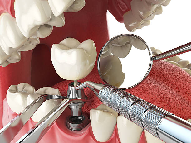 Best Emergency Dentist for Lost Fillings or Crowns in Deer Park, OH